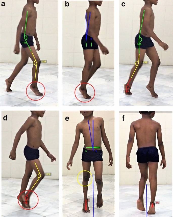 Скриншоты видеозаписи походки, остановленных на шести фазах шага, для записи и измерения различных параметров Эдинбургской визуальной шкалы походки (EVGS)