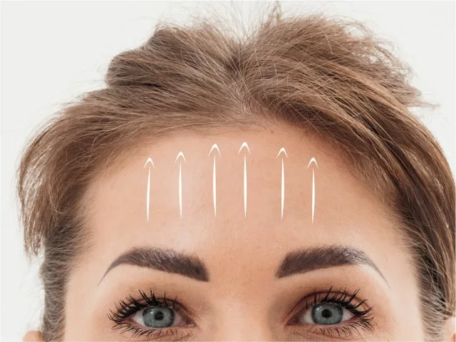 Нитевые методики используют как внутренний каркас, когда ткани опустились, зона лба потеряла тонус и залом остаётся фиксированным даже после расслабления мышцы