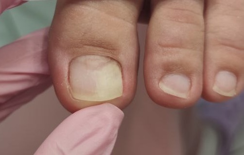 Онихолизис: почему появляются пустоты под ногтями? Лечение и профилактика от подологов