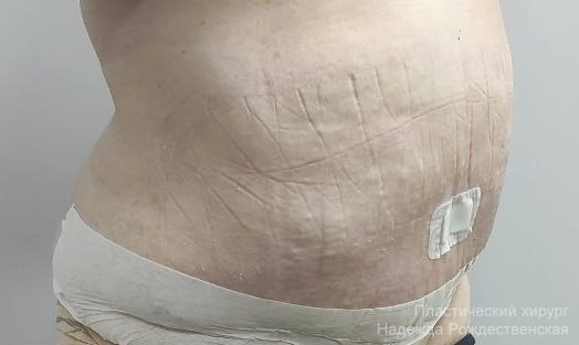    Благодаря операции пациентка сможет вернуться к спортивному образу жизни