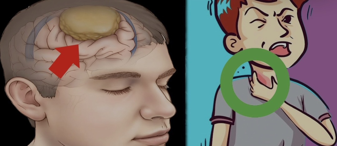 Фибрилляция предсердий: тихий сбой ритма, ведущий к проблемам мозга