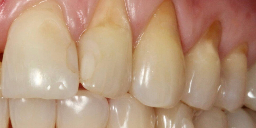 Просто “длинные” зубы? Или опасная патология десны?