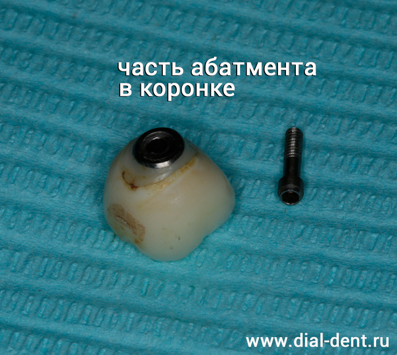 коронку с винтовой фиксацией легко снять с импланта