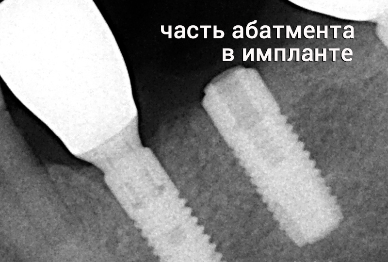 Что делать, если обнаружилась подвижность коронки на импланте