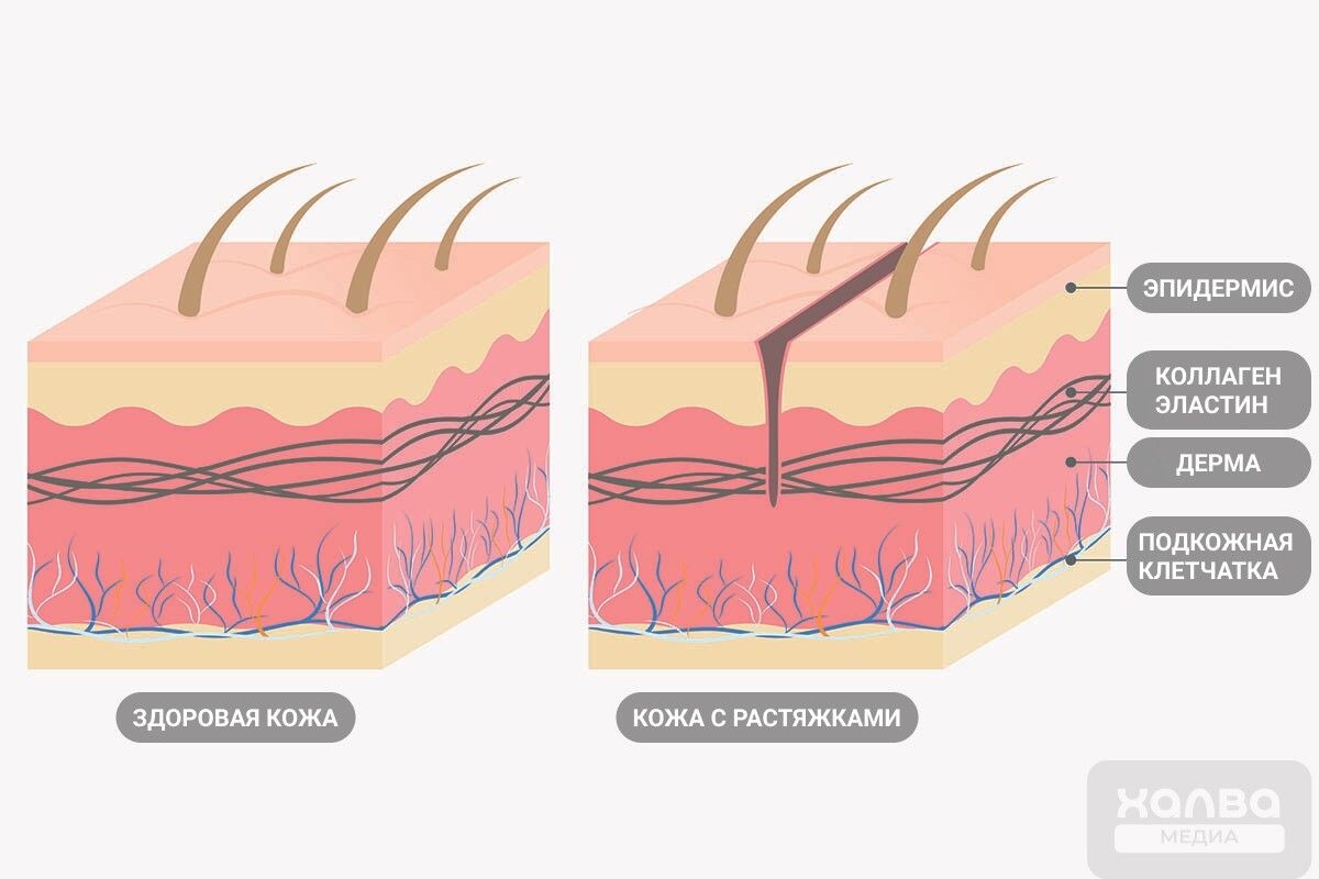Вот как выглядит кожа с растяжками📷
