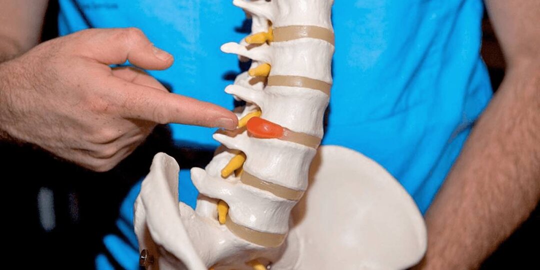 Грыжа позвоночника — не приговор: что можно сделать уже сегодня? Советы врача-остеопата