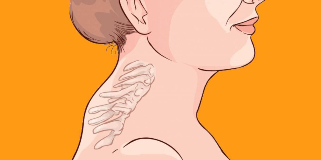 Холка на шее: почему она растёт, чем опасна и как остановить её развитие. Объясняет врач-остеопат