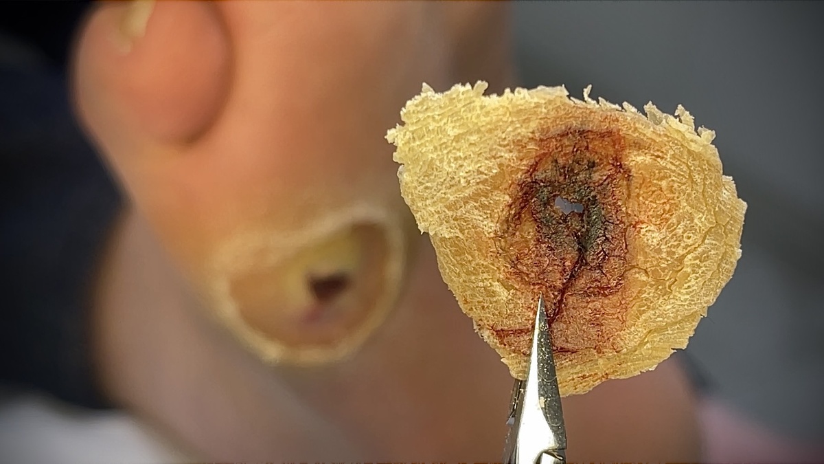 Подолог просверлила в мозоль дыру