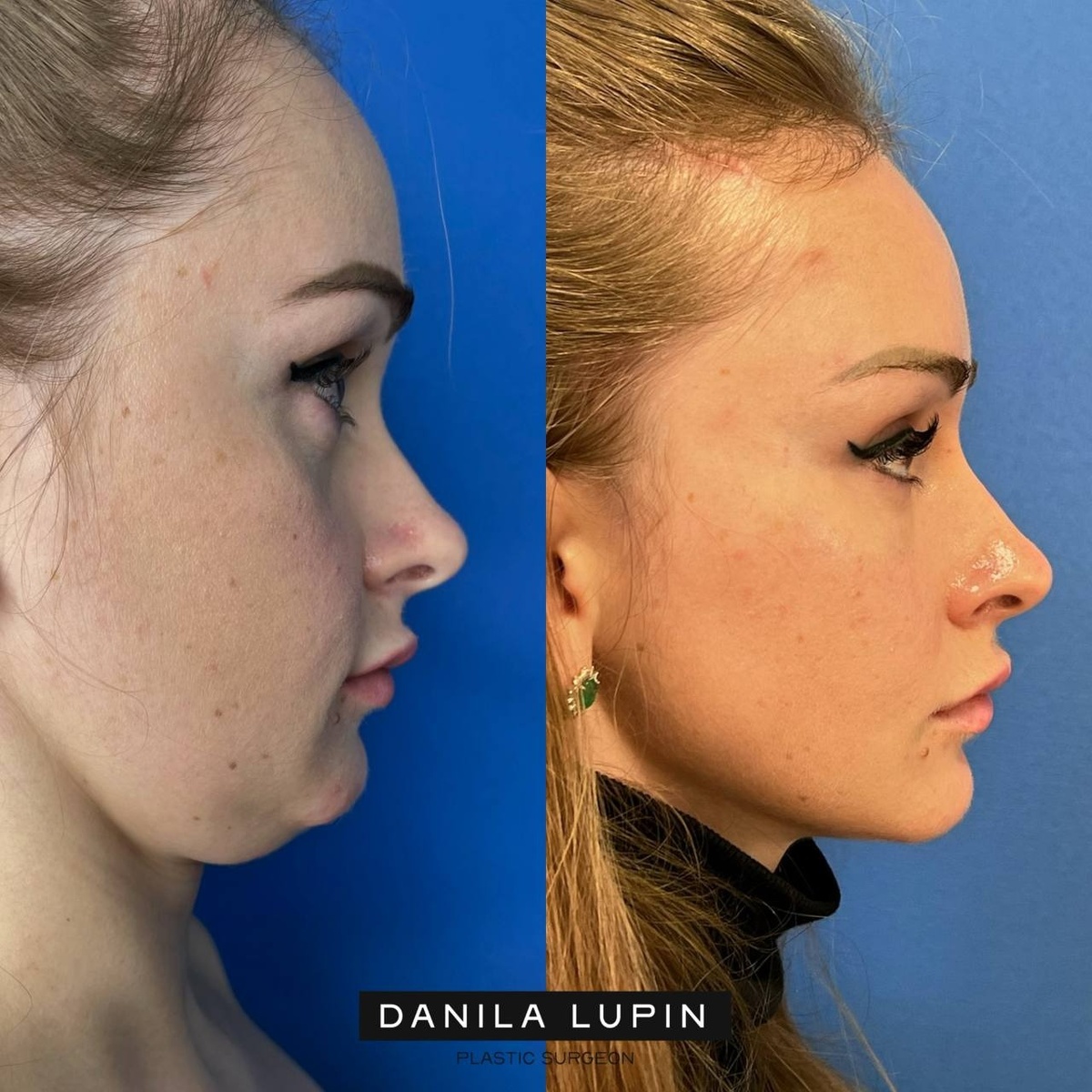 Моя пациентка. Выполнили эндоскопическую подтяжку верхней трети, эндоскопическую подтяжку средней трети, липофилинг верхних и нижних век, липофилинг скуловой и височной области