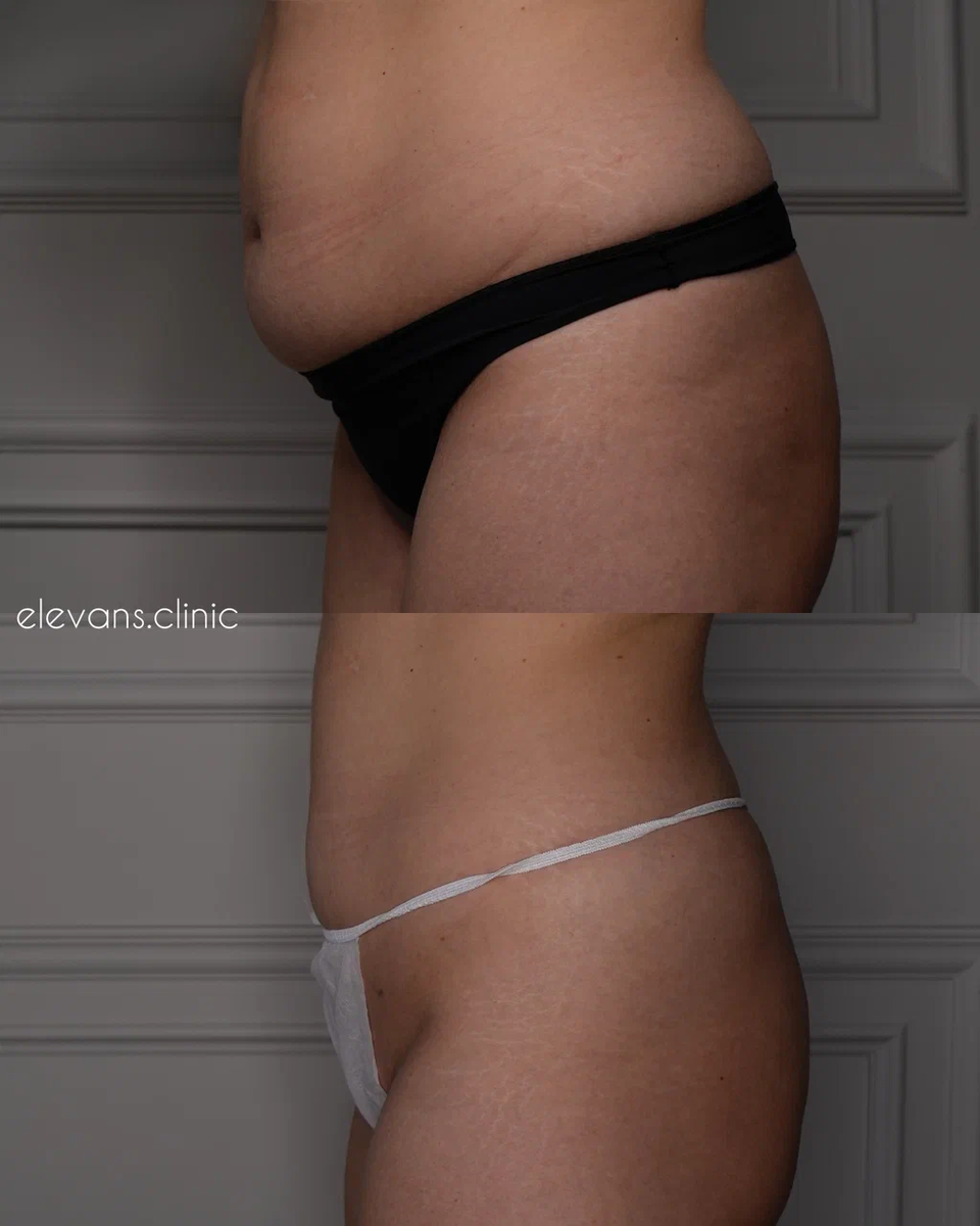 Результат нашей клиентки после процедуры криолиполиза