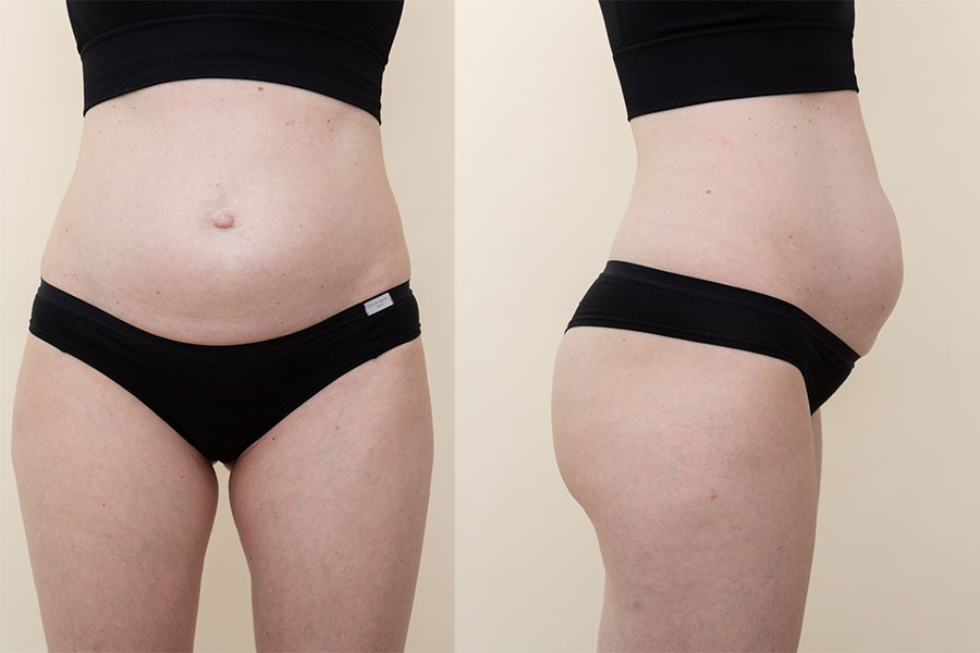 Криолиполиз не применяют при диастазе, поскольку анатомия зоны делает процедуру неэффективной