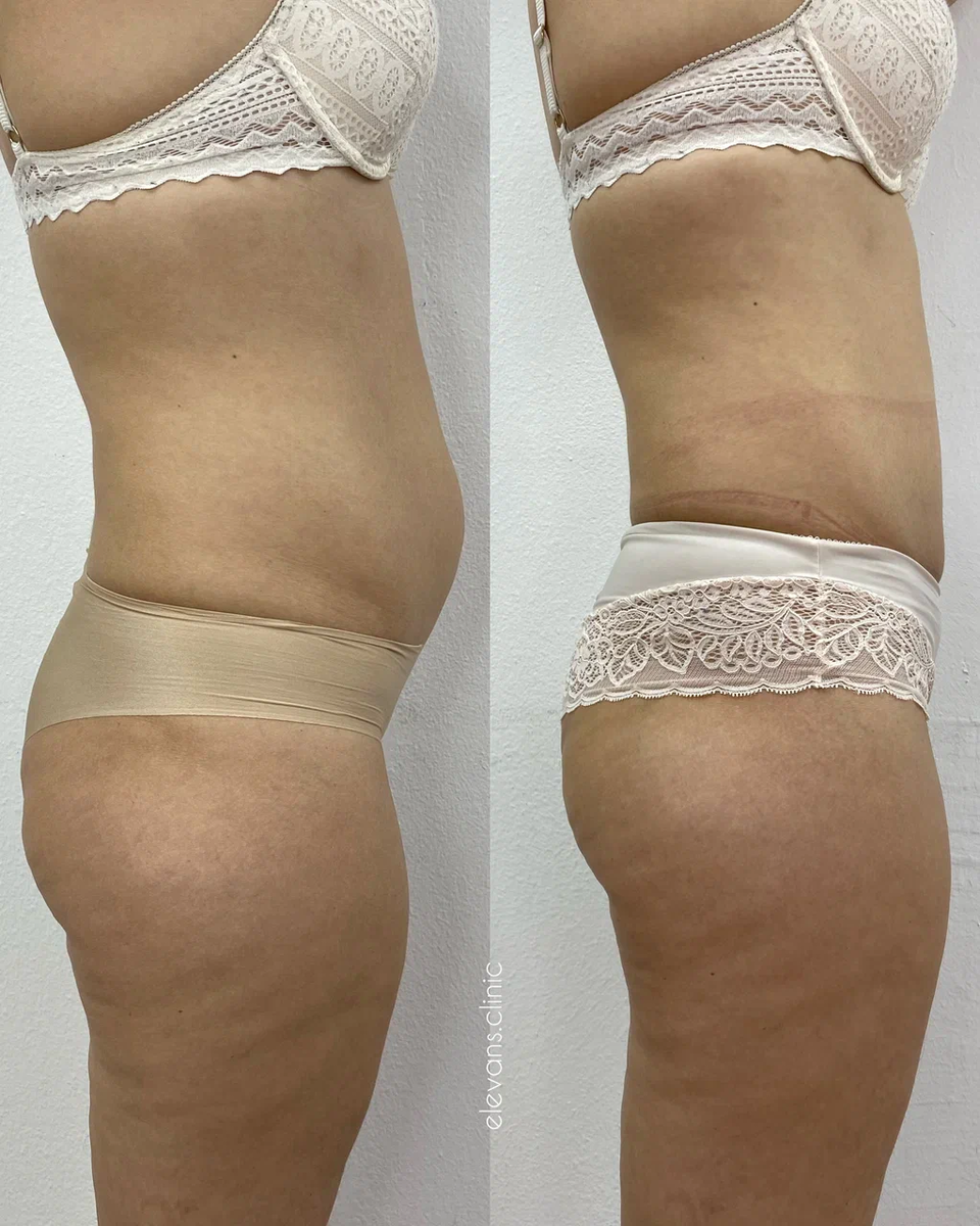 Фото клиентки до и после процедуры криолиполиза