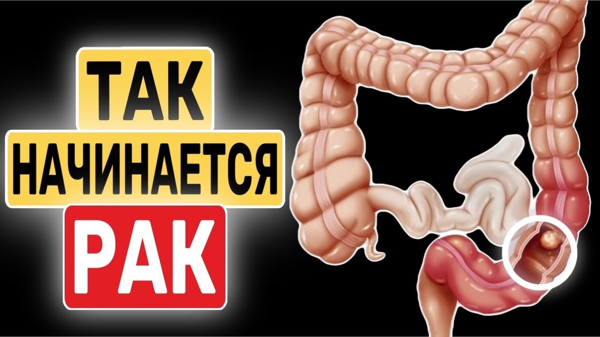 Я год жила с жжением в животе, пока врач не нашёл редкую опухоль кишечника (моя история)