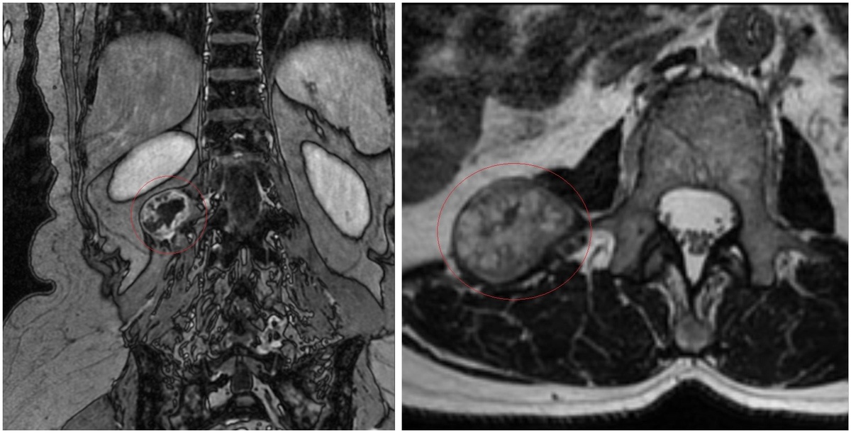 Опухоль выделена красным цветом