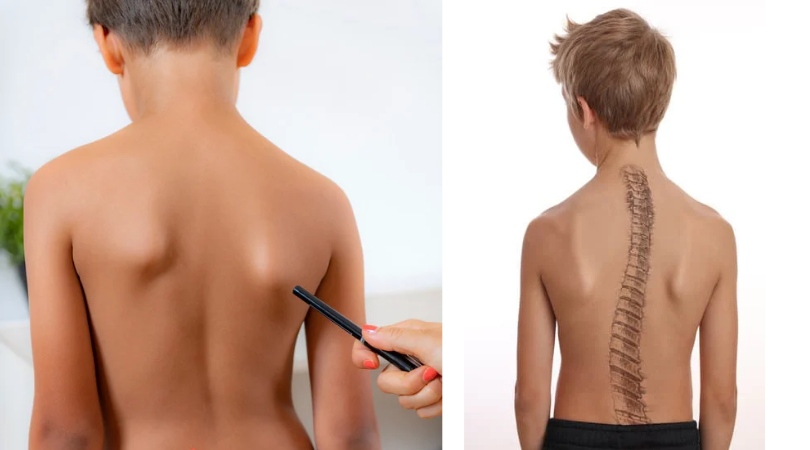 Гиперактивность: как положение спины влияет на внимание вашего ребенка | 3 простых теста для оценки осанки