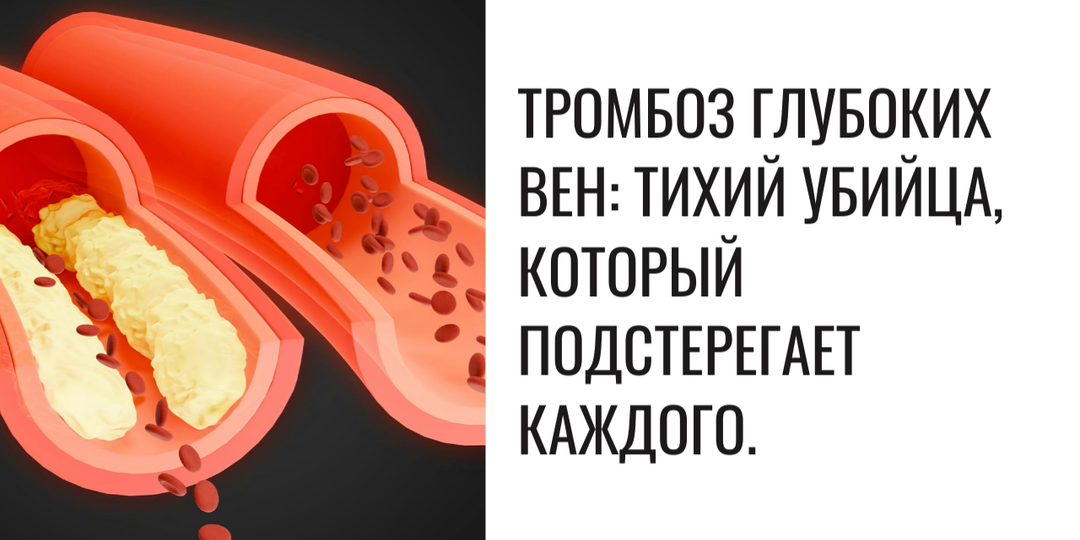 Тромбоз глубоких вен: тихий убийца, который подстерегает каждого.