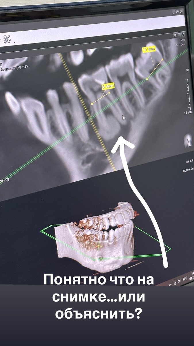 Исходная ситуация на компьютерной томограмме.Сейчас все поймете.