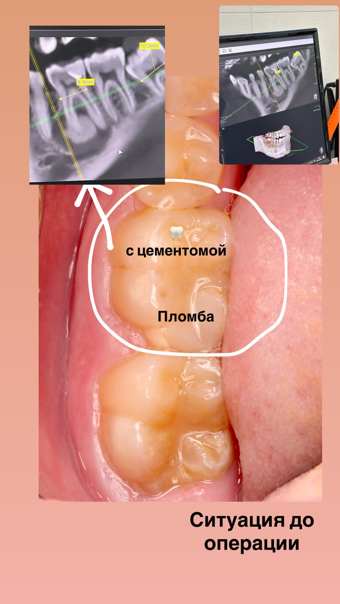 Нижний 6-й зуб с цементомой.Планируется удаление зуба мудрости и пересадка его на место 6-го зуба.