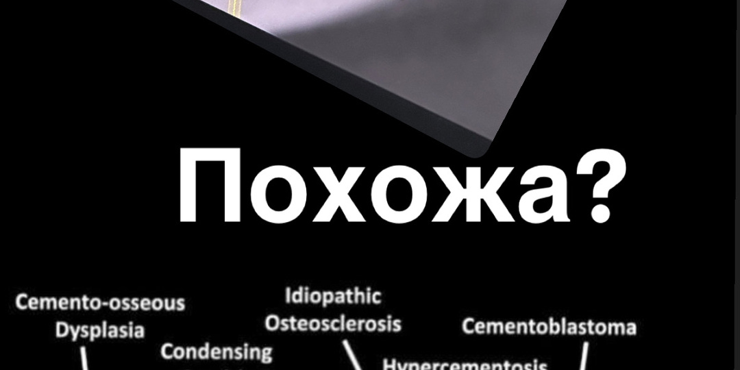 Мы пересадили зуб вместо импланта: уникальная операция для Тамбова