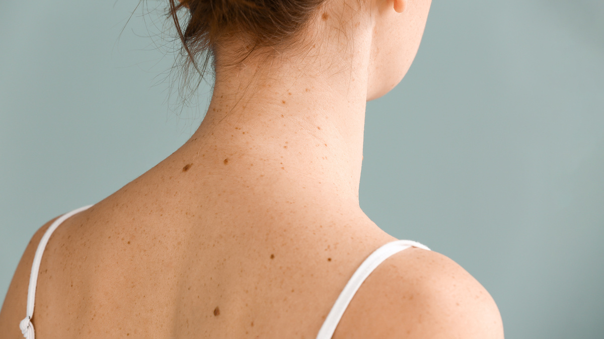     Фото: Pixel-Shot/Shutterstock/FOTODOM Цвет родинки напрямую зависит от глубины скопления меланоцитов: чем ближе к поверхности они расположены, тем светлее и ровнее пятно; чем глубже, тем оно может казаться более выпуклым и темным