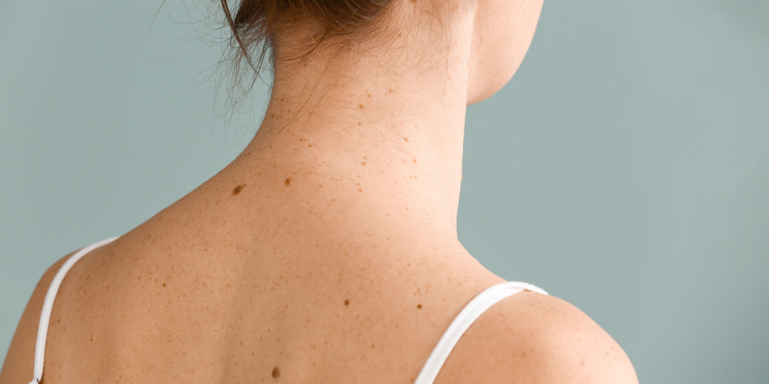 Почему появляются родинки