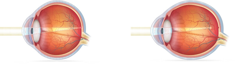 «Нормальный» глаз (слева) и «близорукий» глаз (справа)