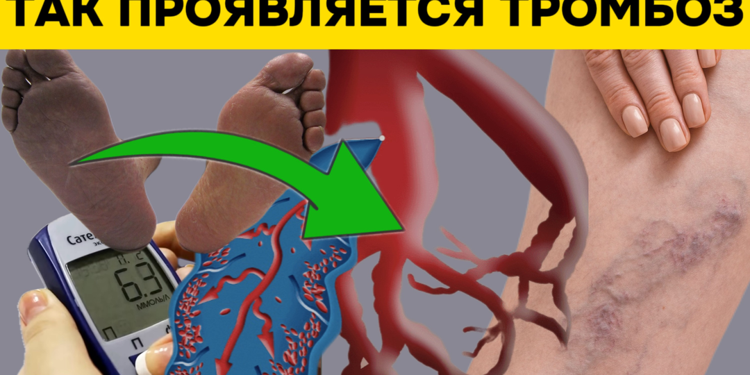 Диагностика тромбоза: 3 симптома, которые врачи сравнивают с красным флагом