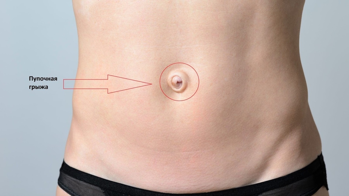 Пупочная грыжа. Источник:https://gormonia.com/services/%D0%BF%D1%83%D0%BF%D0%BE%D1%87%D0%BD%D0%B0%D1%8F-%D0%B3%D1%80%D1%8B%D0%B6%D0%B0-%D0%B6%D0%B0%D0%BB%D0%BE%D0%B1%D1%8B-%D0%BF%D1%80%D0%B8%D1%87%D0%B8%D0%BD%D1%8B-%D0%BF%D0%BE%D1%8F%D0%B2%D0%BB%D0%B5/