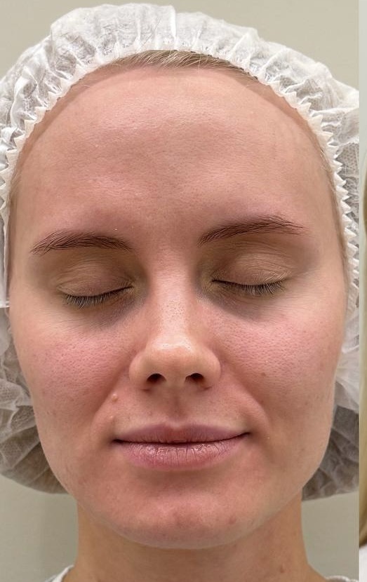 моя кожа до процедуры