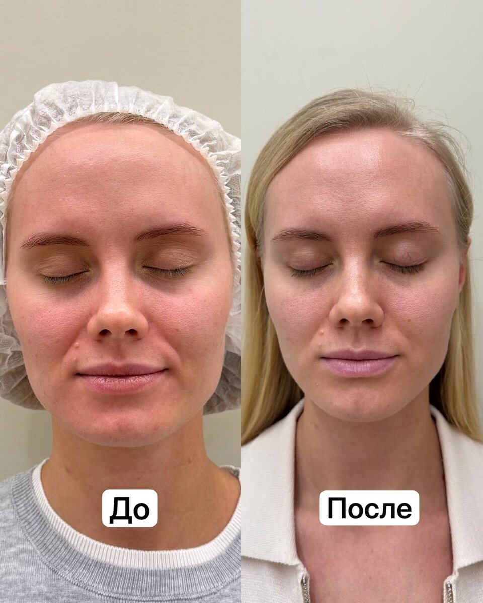 Спустя одну процедуру