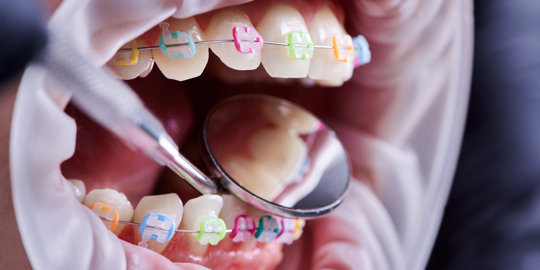 Как подготовиться к установке брекетов