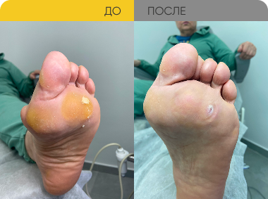 Обработка вальгусной стопы подологом