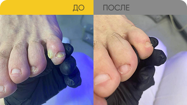 Обработка межпальцевой мозоли подологом