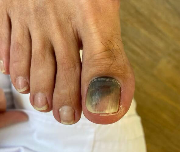 Подногтевая гематома