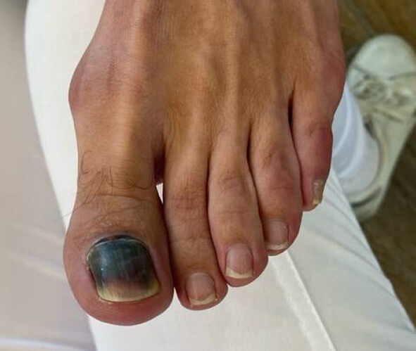 Подногтевая гематома