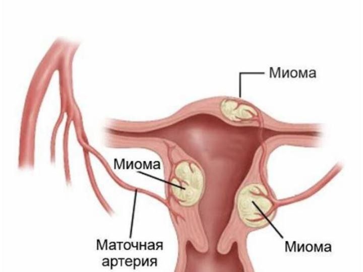#миомаматки #миомаматкилечение #миомаматкиоперация #миомаматкилапароскопия #гинекологмосква #гинекологкраснодар