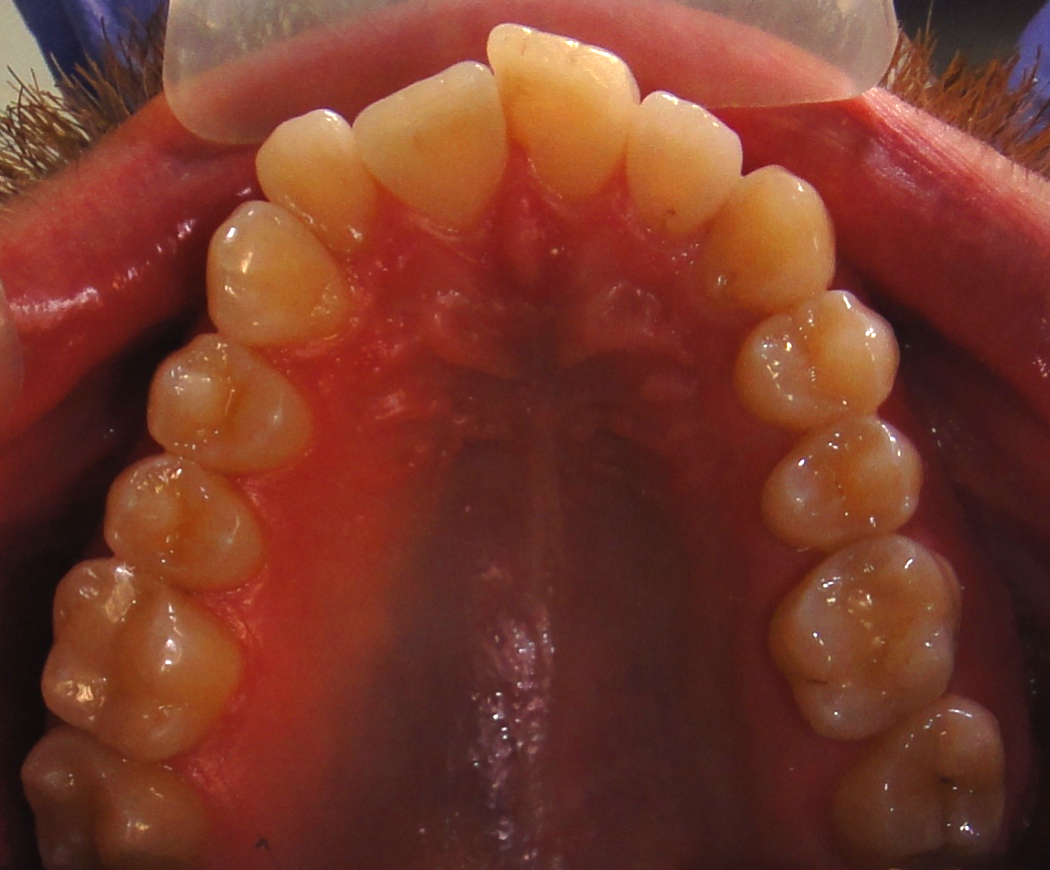 верхняя челюсть