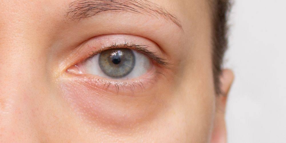 «Мешки» под глазами часто вызваны смещением жировых пакетов, а не кожей.