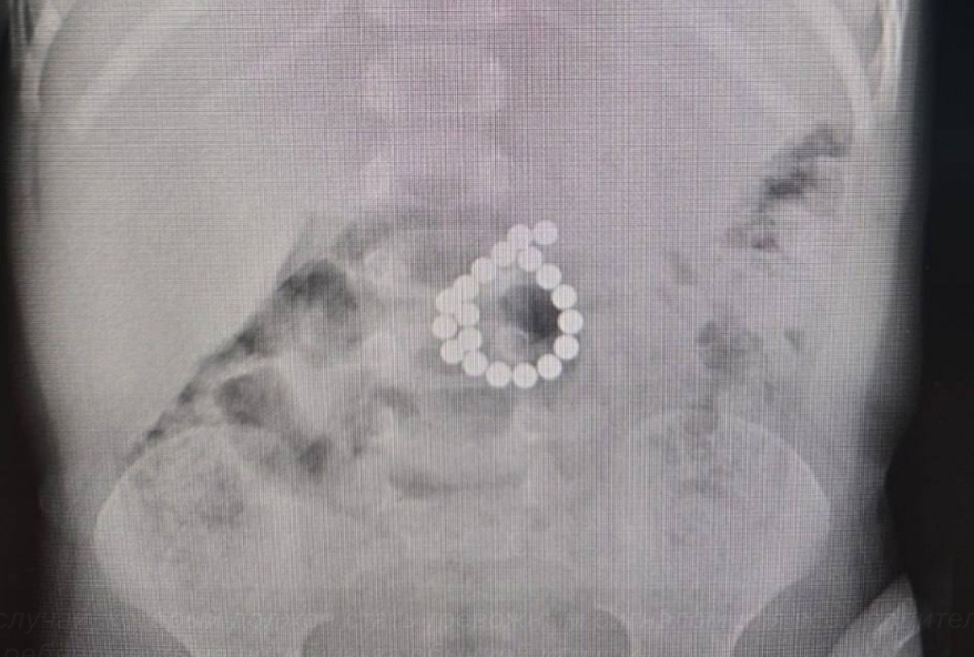    Двухлетний ребенок в Югре проглотил 19 магнитов от конструктора