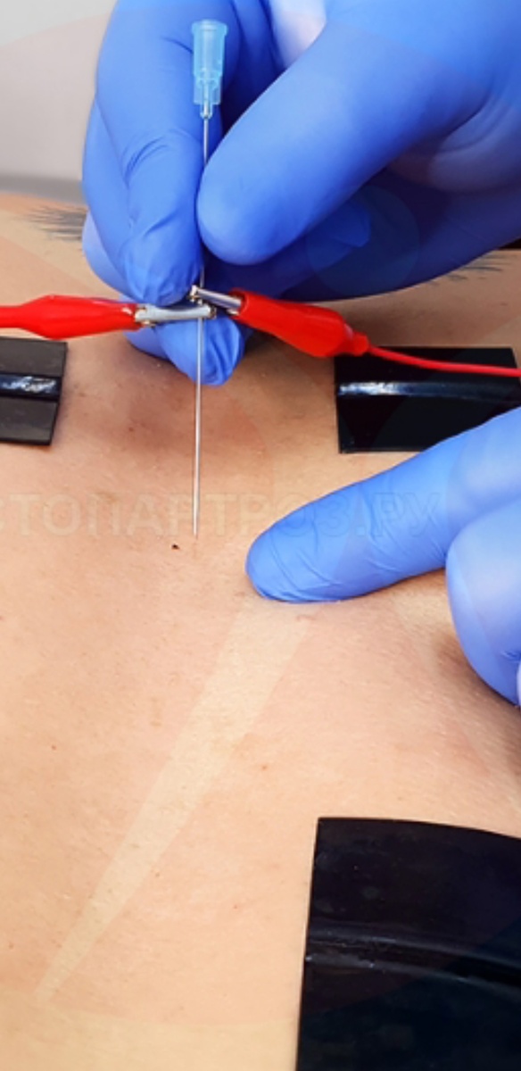 Внутритканевая электростимуляция. Фото из свободного доступа в интернет.