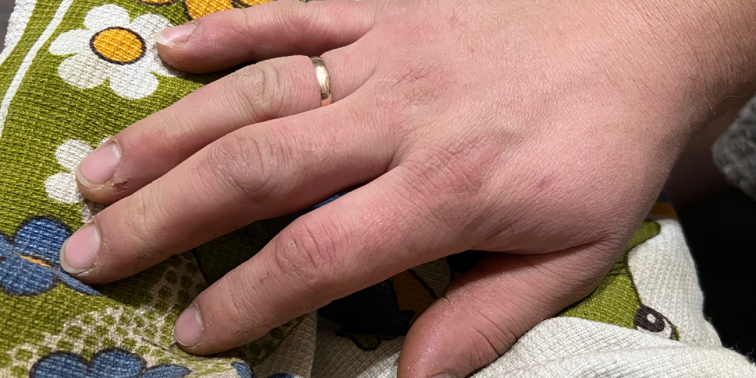 Признаки сахарного диабета по ногтям. 5 показателей, которые не стоит упускать