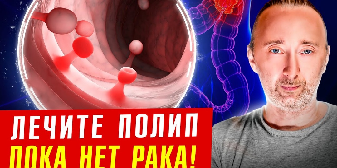Ранние симптомы полипов кишечника, про которые мало кто знает