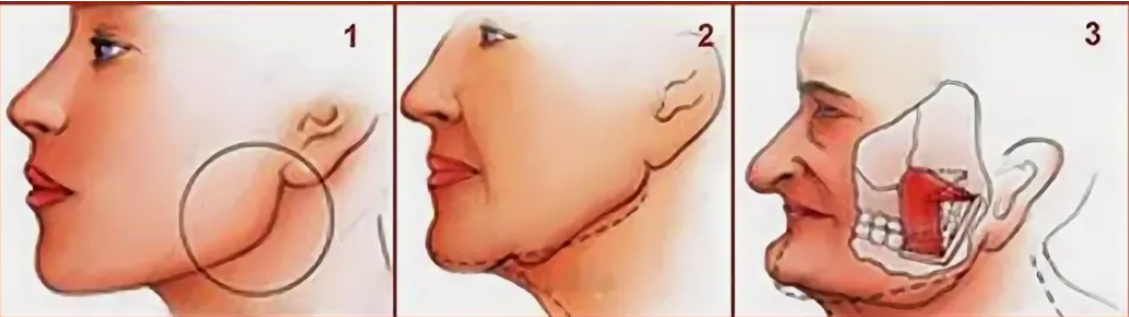 изменения жевательных мышц и их влияние на молодость лица