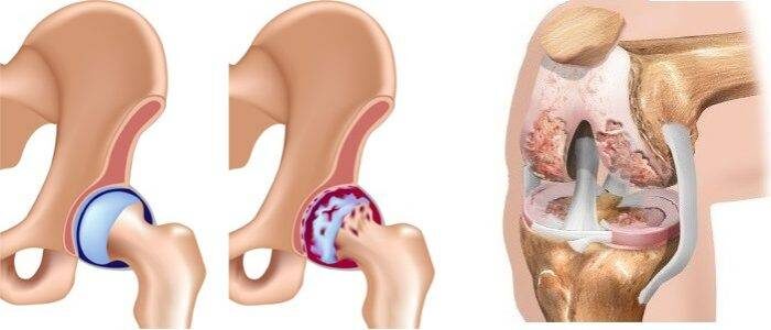 Коксартроз: сигнал — пора слушать своё тело