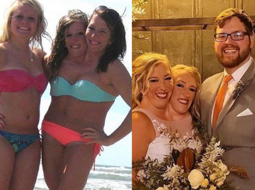 «Когда сестра делает это с мужем, то я отворачиваюсь»: как делят одного супруга сиамские сестры-близняшки Хенсель