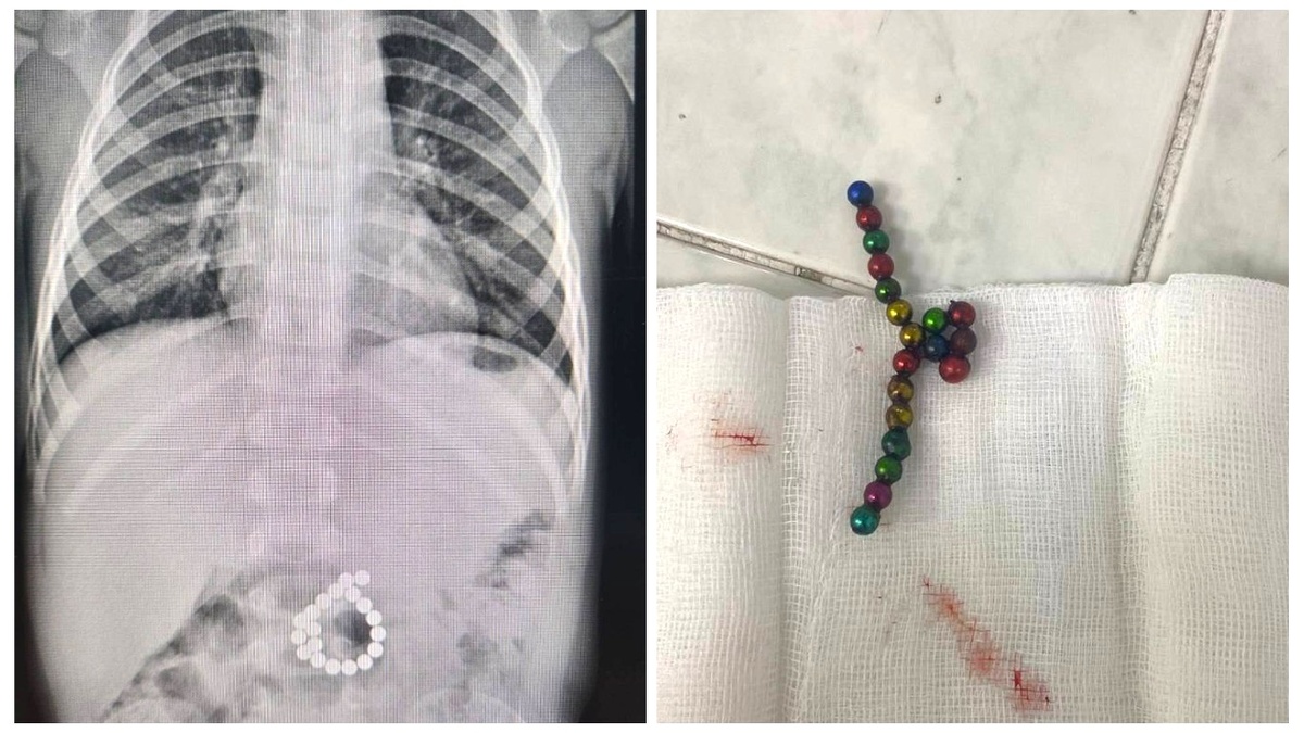    Магнитный конструктор - опасная игрушка: в Сургуте прооперировали ребёнка, проглотившего детали конструктора