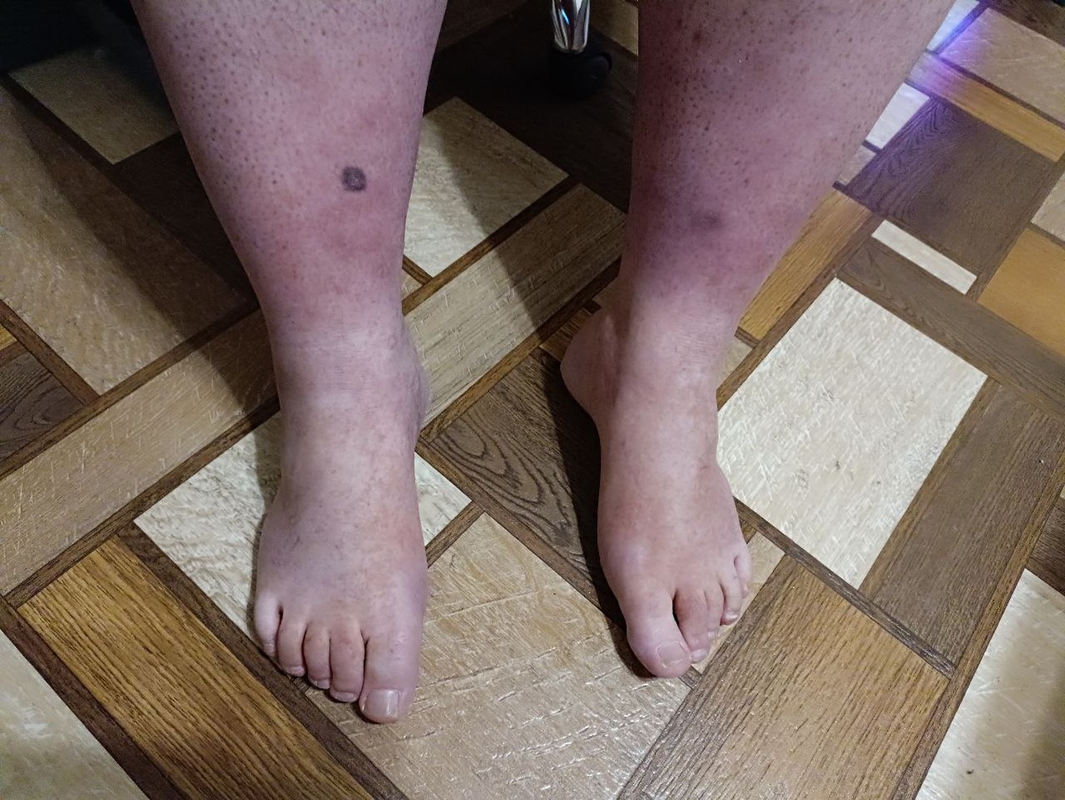 Здесь еще осталась краснота и звёздочки начали затухать(активно месяц пользовался кремом) Кому интересно пишите в личку скажу название.  