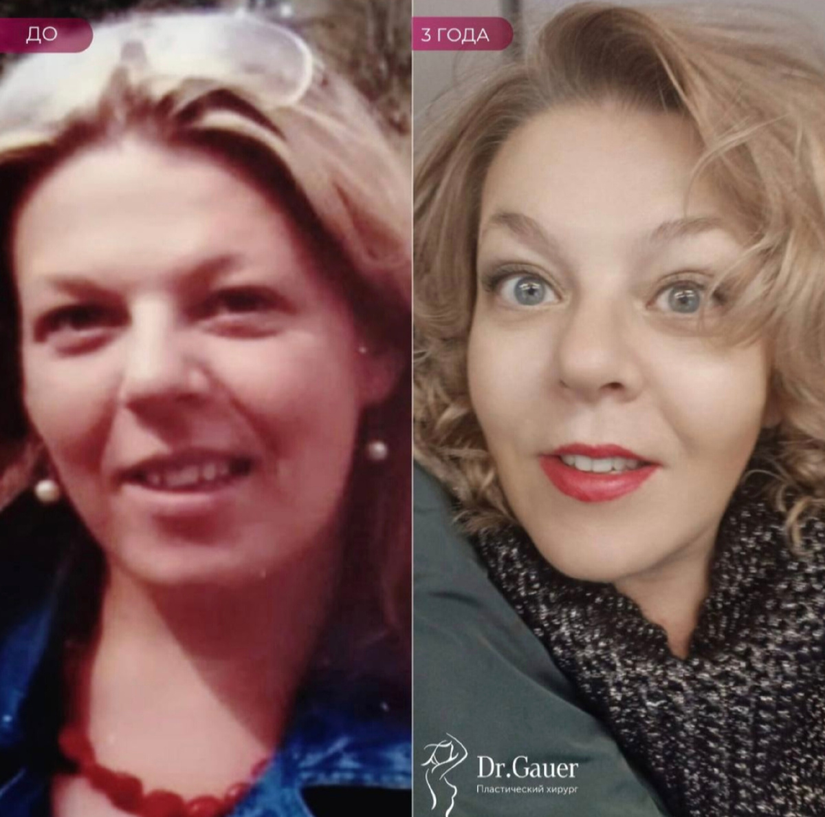 Результат пластической операции