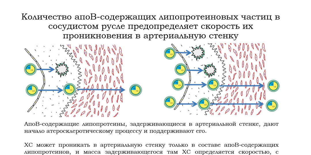 Атеросклероз вызван воспалением, или же холестерином?