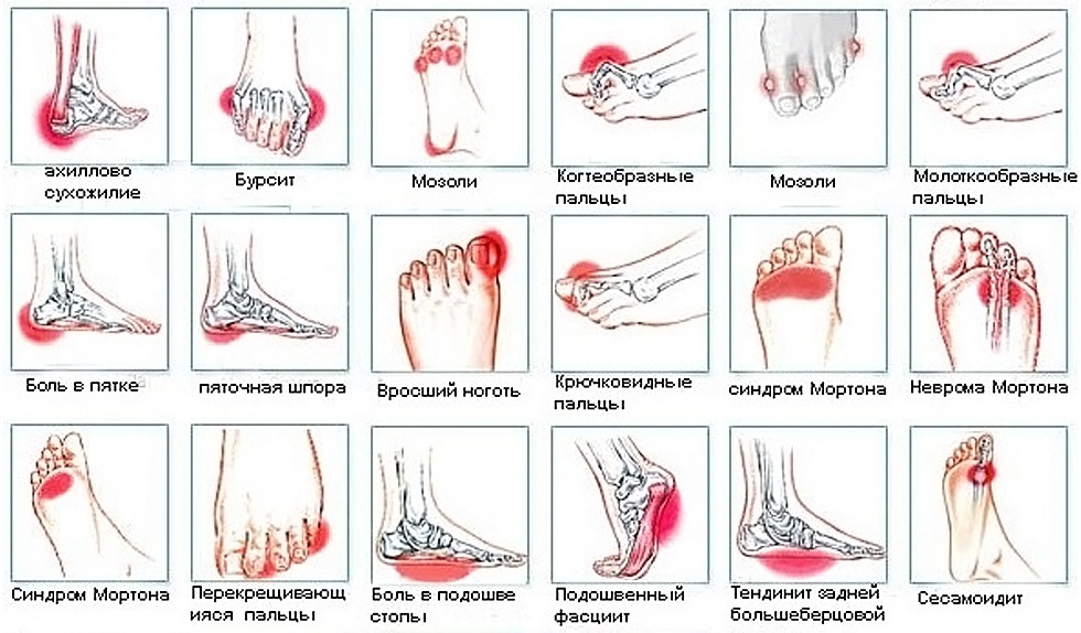 Проблемные зоны стоп